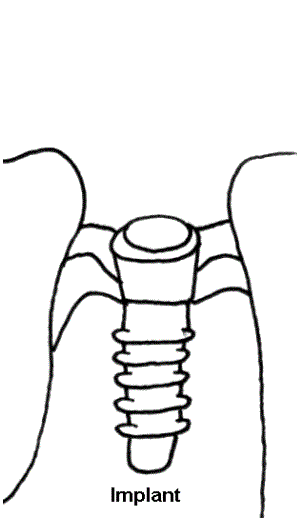 drawing one of dental implant