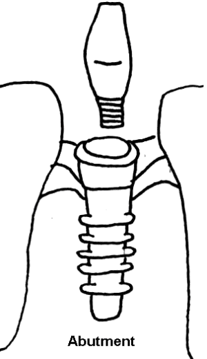 drawing two of dental implant