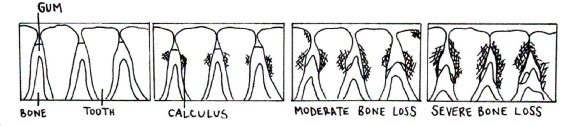 drawing of teeth showing various stages of periodontal disease